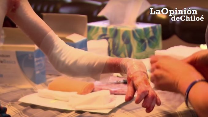 epidermólisis bullosa