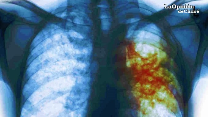tuberculosis