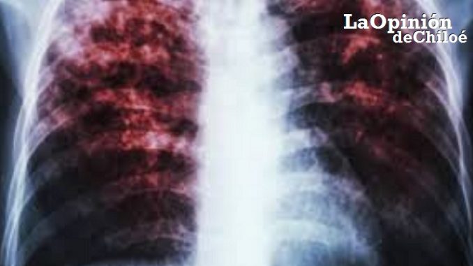 tuberculosis3