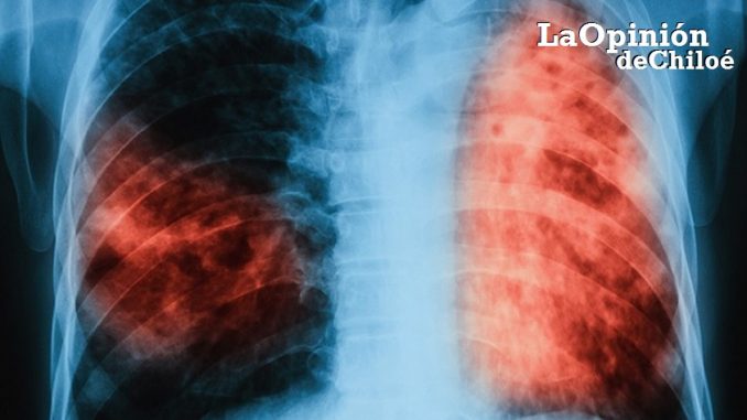 tuberculosis4