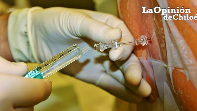 epidural